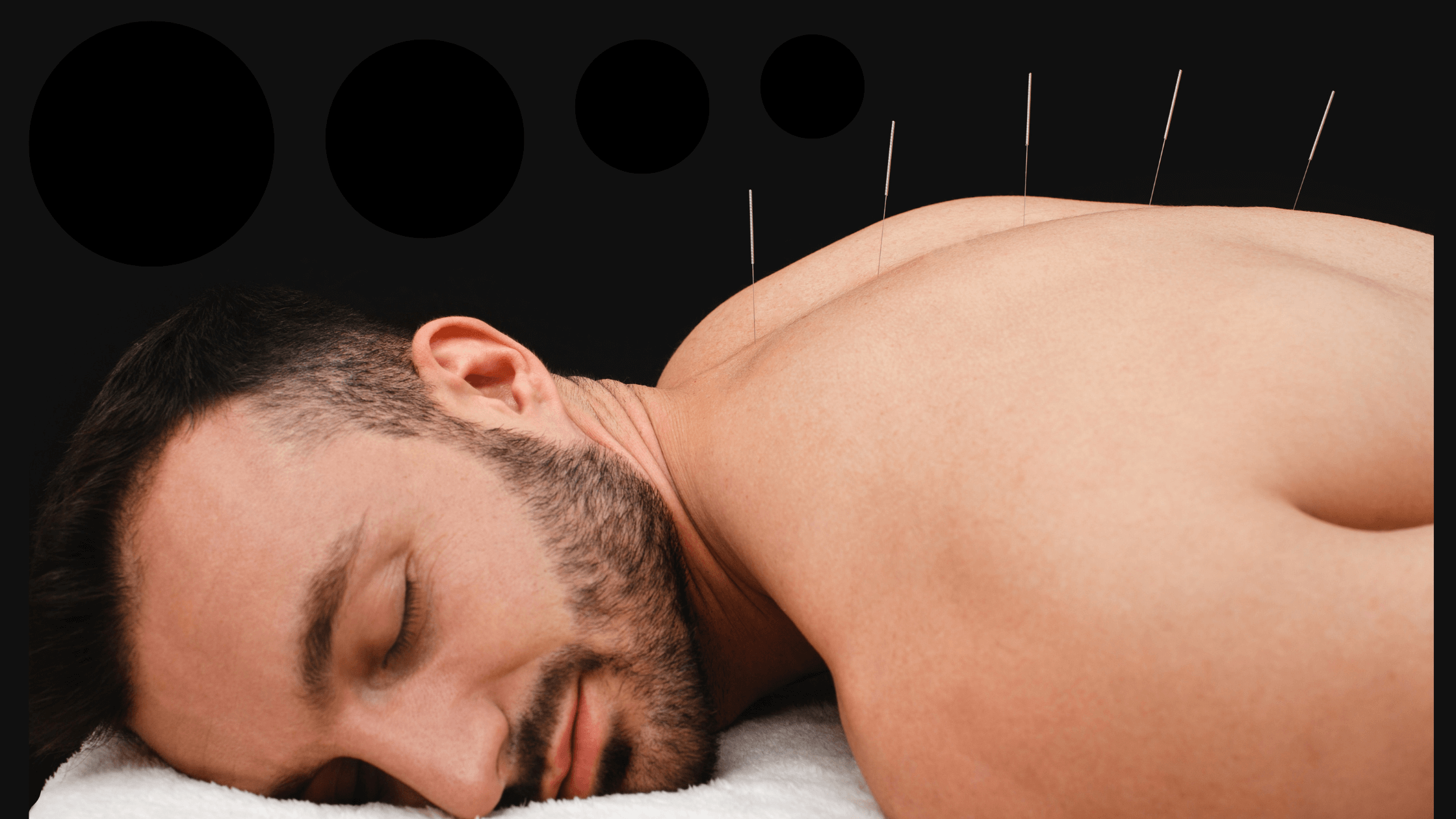 Young, short-bearded man lies with his face to one side with acupuncture needles in his back looking very relaxed and comforable