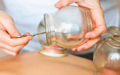 Traditional Chinese Medicine 101: What is Cupping?